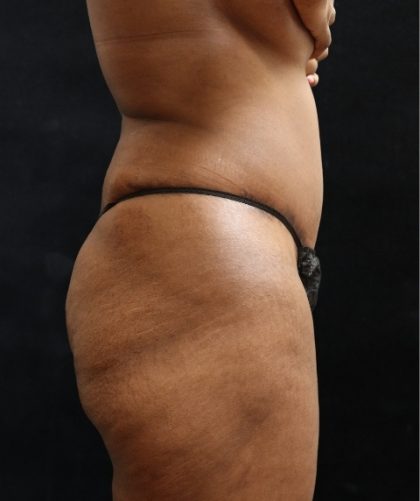 Tummy Tuck Before & After Patient #11527