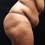 Tummy Tuck Before & After Patient #11527