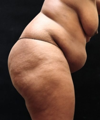 Tummy Tuck Before & After Patient #11527