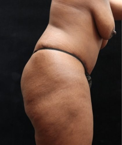 Tummy Tuck Before & After Patient #11527