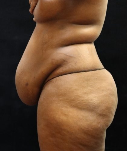 Tummy Tuck Before & After Patient #11527