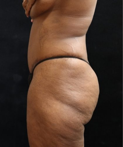 Tummy Tuck Before & After Patient #11527