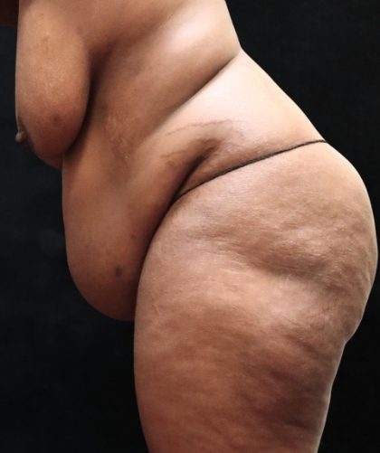 Tummy Tuck Before & After Patient #11527