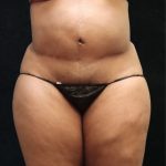 Tummy Tuck Before & After Patient #11528