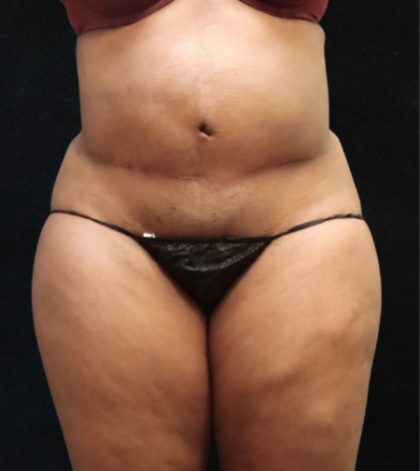 Tummy Tuck Before & After Patient #11528