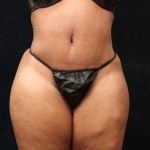 Tummy Tuck Before & After Patient #11528