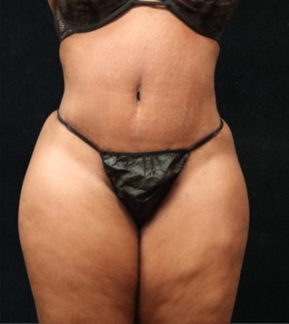 Tummy Tuck Before & After Patient #11528