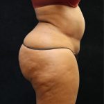 Tummy Tuck Before & After Patient #11528