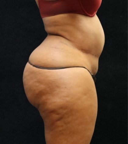 Tummy Tuck Before & After Patient #11528