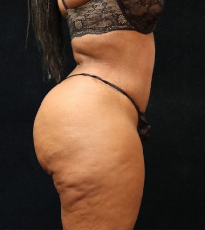 Tummy Tuck Before & After Patient #11528