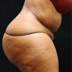 Tummy Tuck Before & After Patient #11528