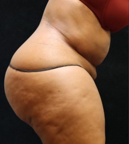Tummy Tuck Before & After Patient #11528