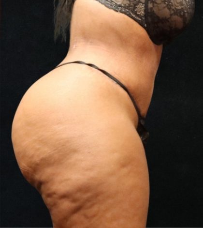 Tummy Tuck Before & After Patient #11528