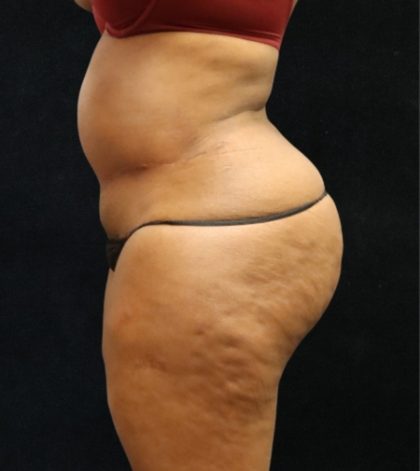 Tummy Tuck Before & After Patient #11528