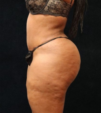 Tummy Tuck Before & After Patient #11528