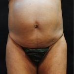 Tummy Tuck Before & After Patient #11529