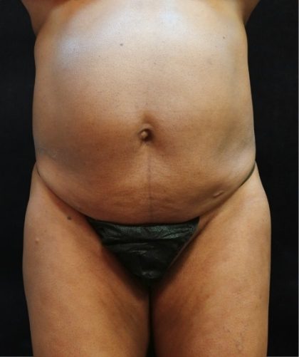 Tummy Tuck Before & After Patient #11529