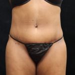 Tummy Tuck Before & After Patient #11529