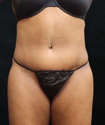 Tummy Tuck Before & After Patient #11529