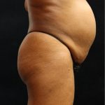 Tummy Tuck Before & After Patient #11529