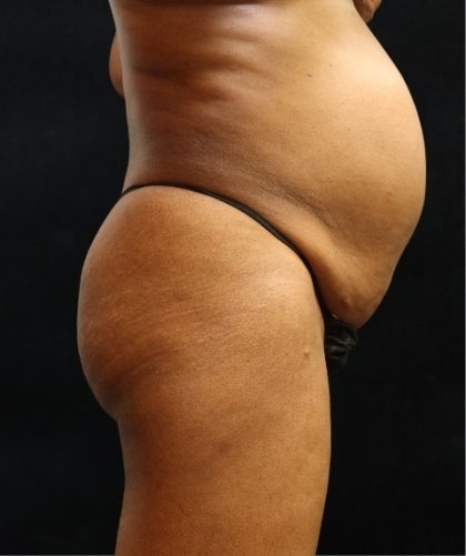 Tummy Tuck Before & After Patient #11529