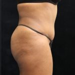 Tummy Tuck Before & After Patient #11529