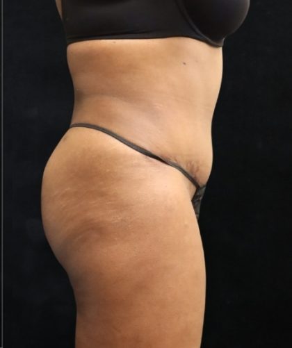 Tummy Tuck Before & After Patient #11529