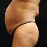 Tummy Tuck Before & After Patient #11529