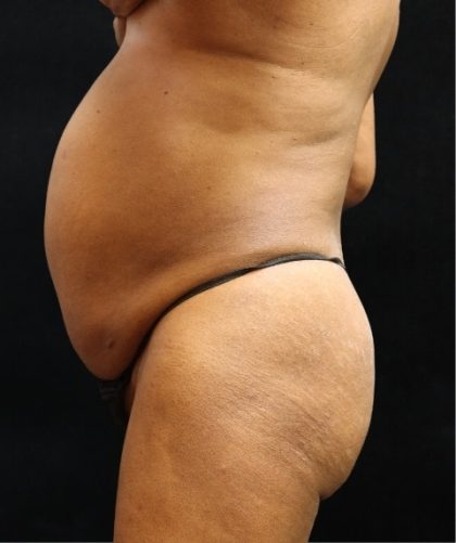 Tummy Tuck Before & After Patient #11529