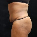 Tummy Tuck Before & After Patient #11529