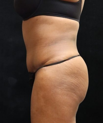 Tummy Tuck Before & After Patient #11529
