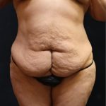 Tummy Tuck Before & After Patient #11530
