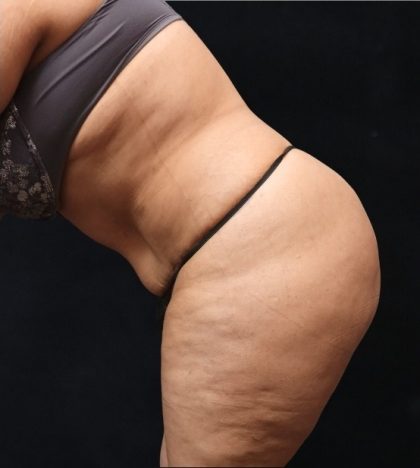 Tummy Tuck Before & After Patient #11530