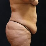 Tummy Tuck Before & After Patient #11530