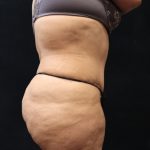 Tummy Tuck Before & After Patient #11530