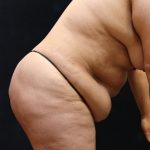Tummy Tuck Before & After Patient #11530
