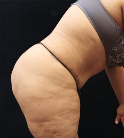 Tummy Tuck Before & After Patient #11530