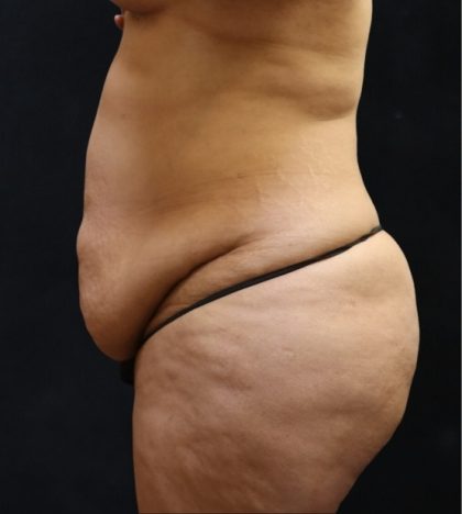 Tummy Tuck Before & After Patient #11530
