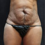 Tummy Tuck Before & After Patient #11531