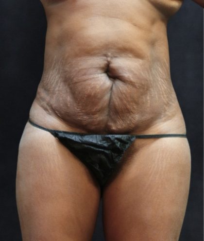 Tummy Tuck Before & After Patient #11531