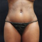Tummy Tuck Before & After Patient #11531