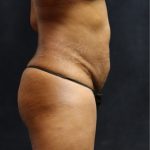 Tummy Tuck Before & After Patient #11531