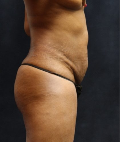 Tummy Tuck Before & After Patient #11531
