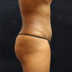 Tummy Tuck Before & After Patient #11531