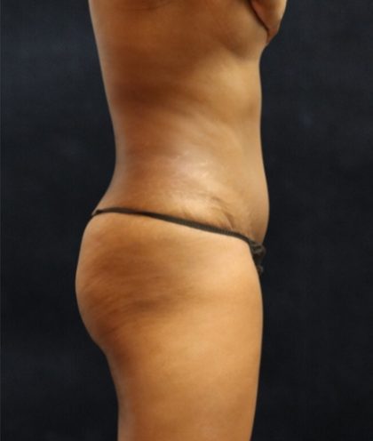 Tummy Tuck Before & After Patient #11531