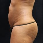 Tummy Tuck Before & After Patient #11531