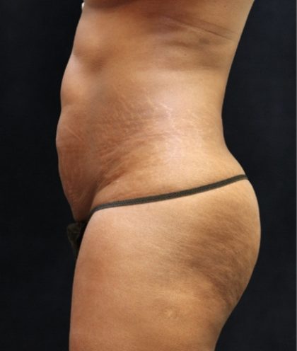 Tummy Tuck Before & After Patient #11531