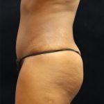 Tummy Tuck Before & After Patient #11531