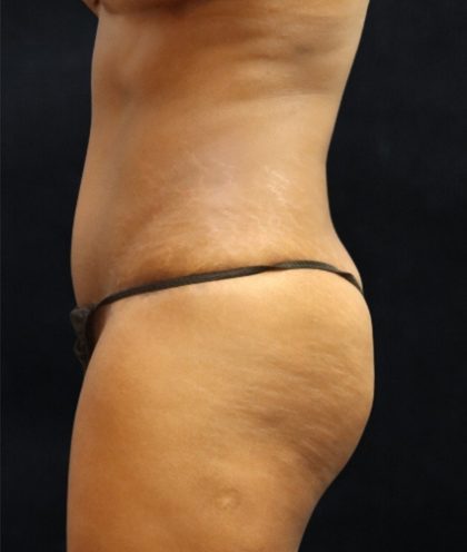 Tummy Tuck Before & After Patient #11531