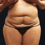 Tummy Tuck Before & After Patient #11532